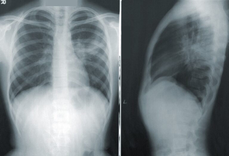 chest x-ray